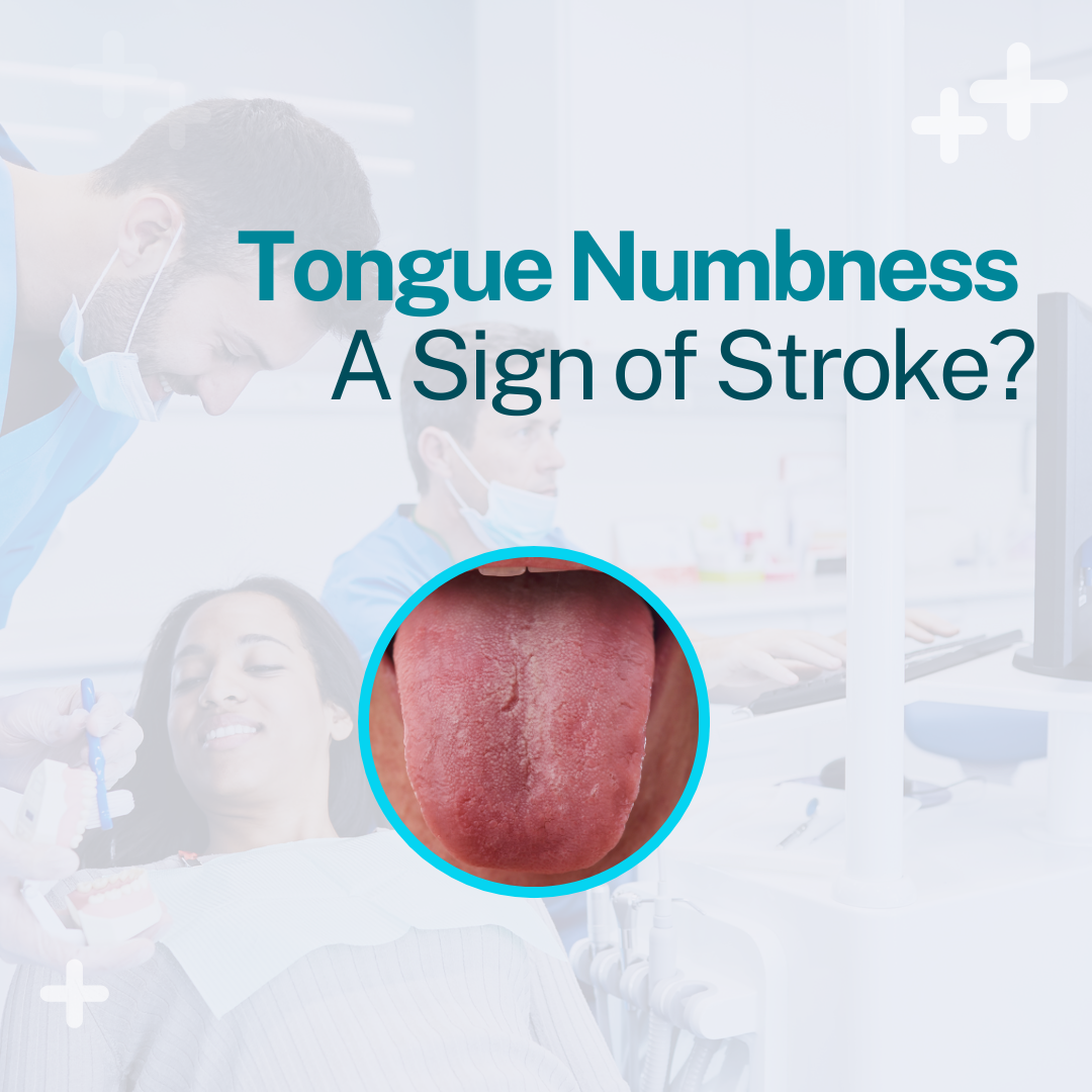 Tongue Numbness - a Sign of Stroke?