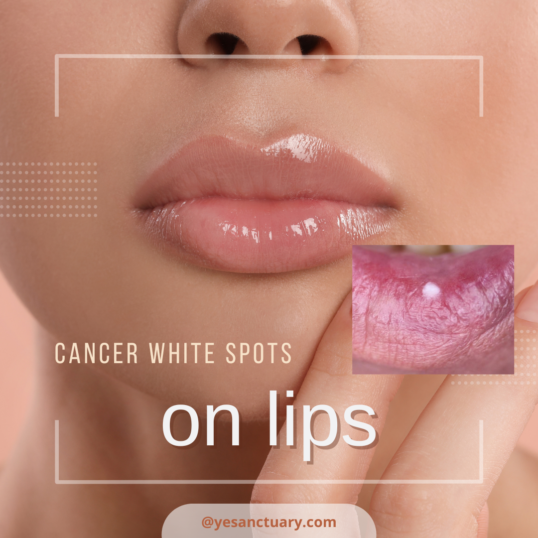 Cancer White Spots on Lips
