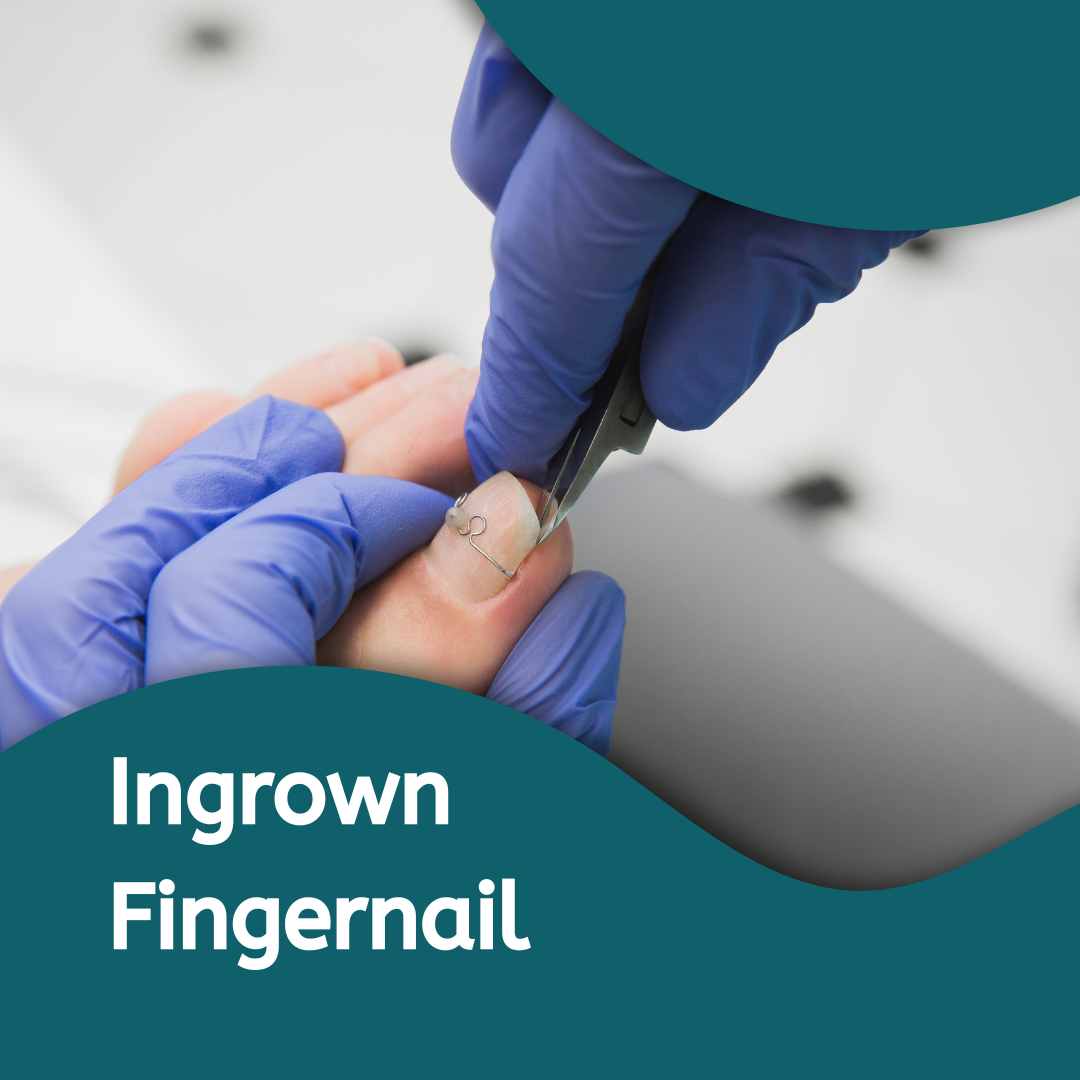 Ingrown Fingernails