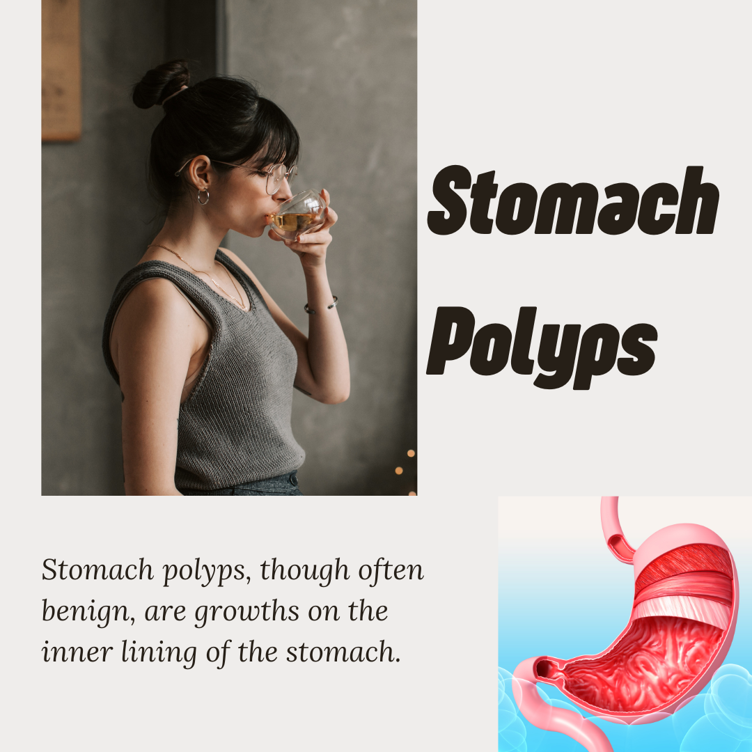 Stomach Polyps: Prevention, Nutrition, and Emotional Well-being